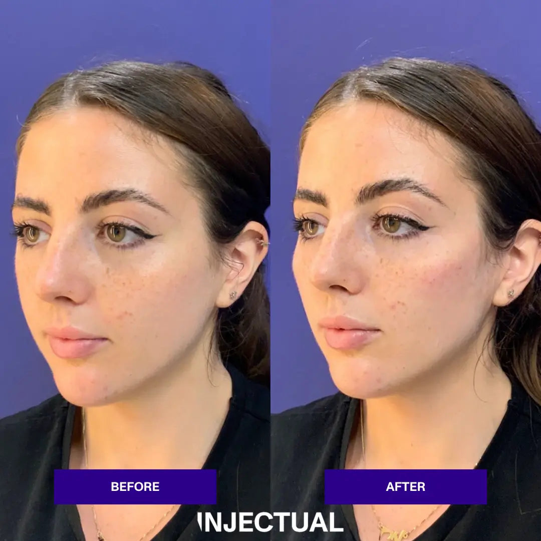 Cheek Filler Treatment in London Injectua injectual