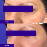 Polynucleotides Ameela® (Nucleadyn®) Under Eye Treatment