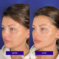 The INJECTUAL Artistic Transformation (Facelift)