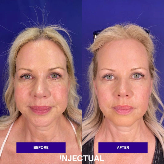 Anti-wrinkle treatment with Alluzience (Express Toxin)