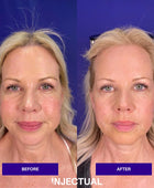 Anti-wrinkle treatment with Alluzience (Express Toxin)