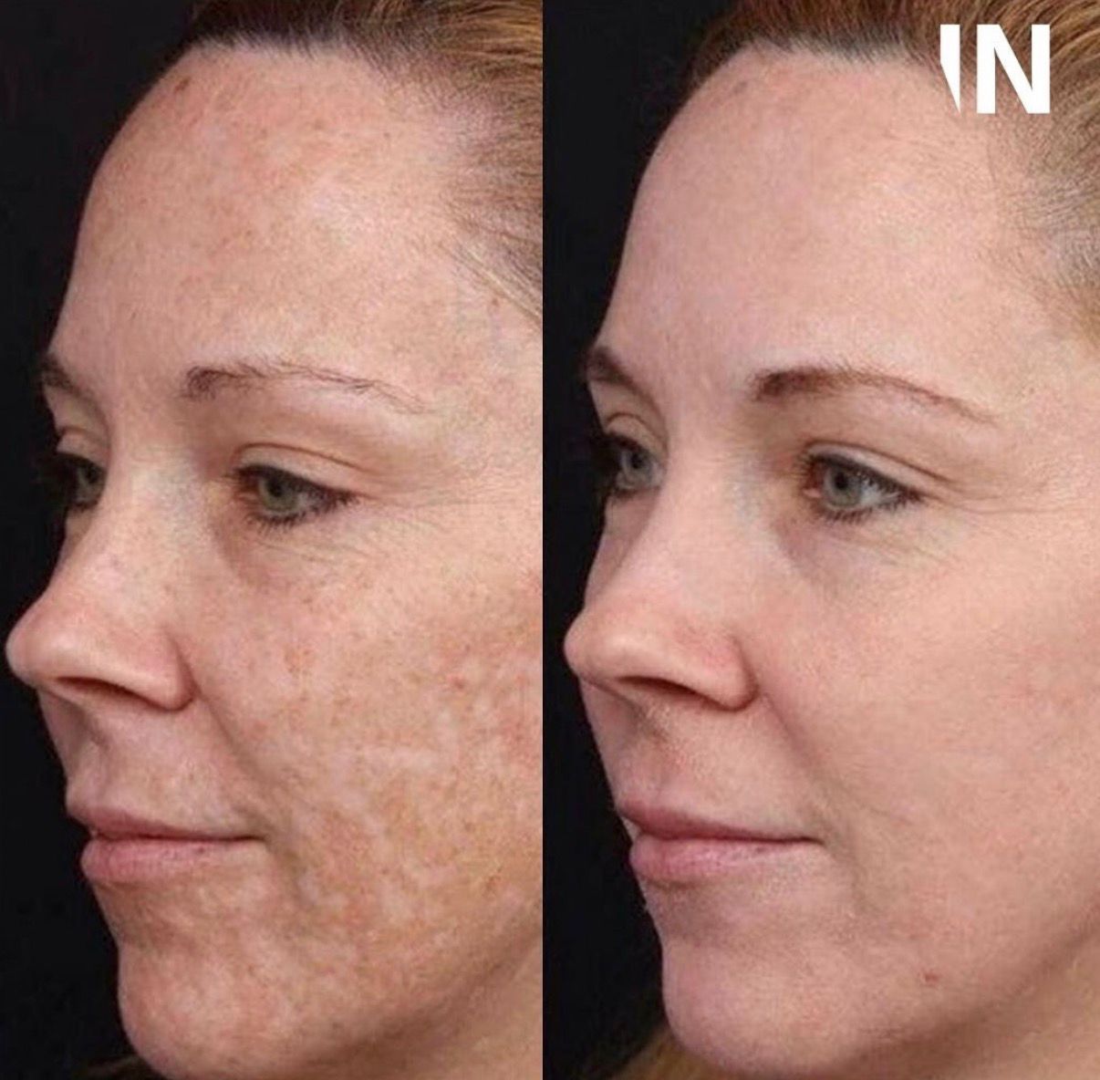 PRX-T33 Skin Peel London | Injectual