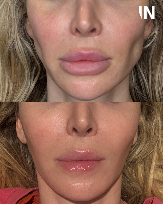 The Injectual Polynucleotide Cocktail XL