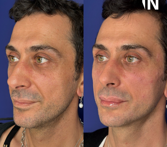 Non-surgical Gender Affirming Treatments