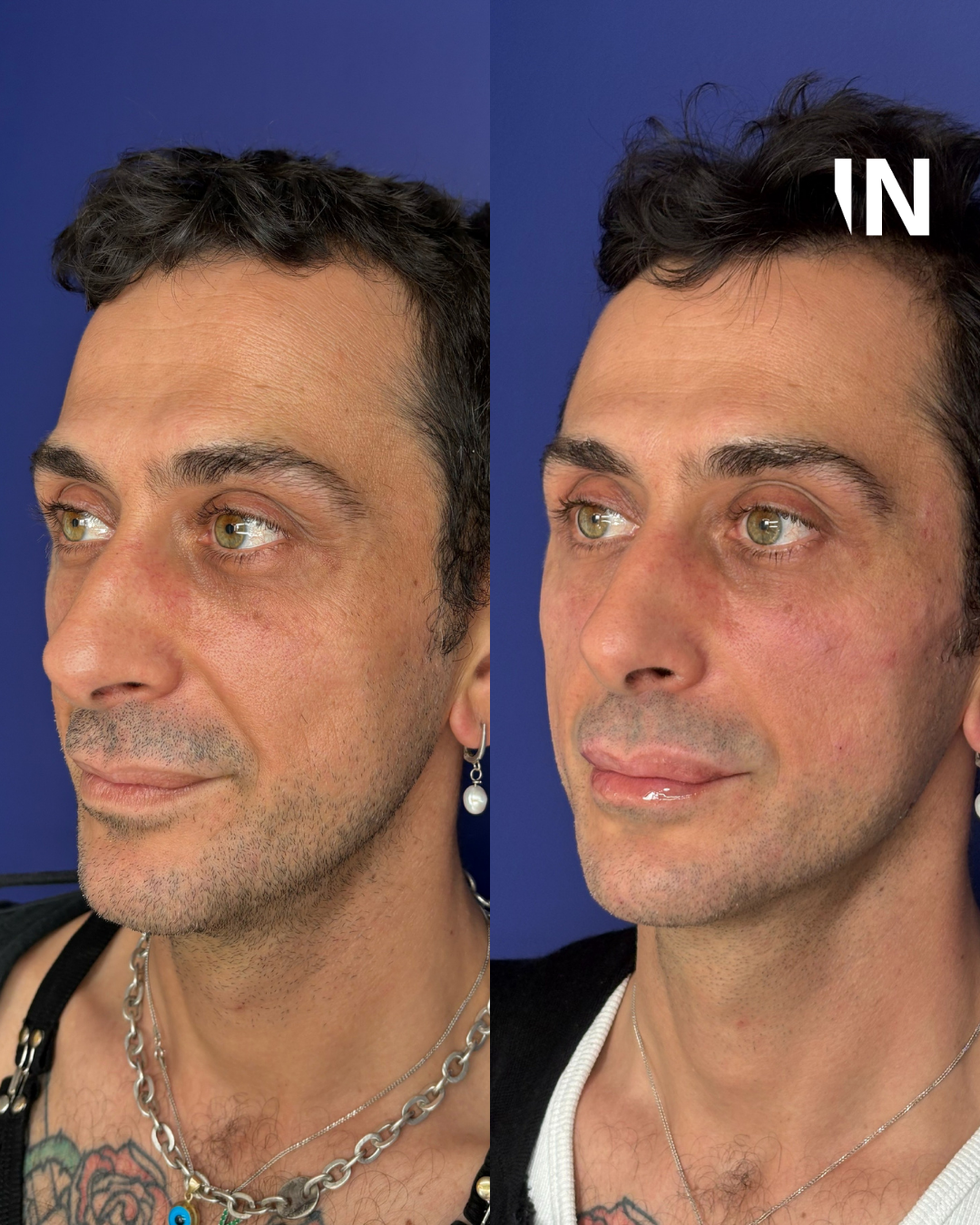 Non-surgical Gender Affirming Treatments