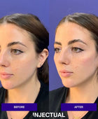 Cheek Filler