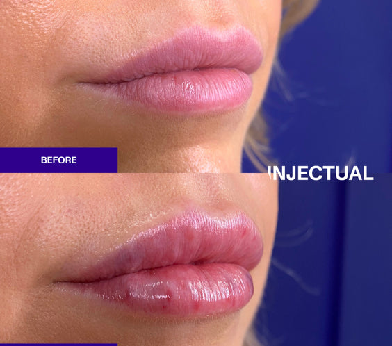 The INJECTUAL Lip