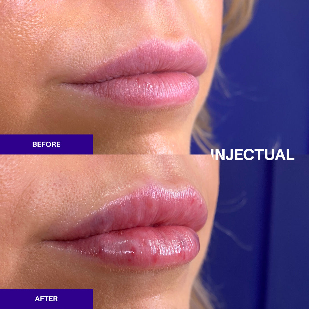 The INJECTUAL Lip