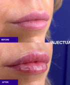 The INJECTUAL Lip