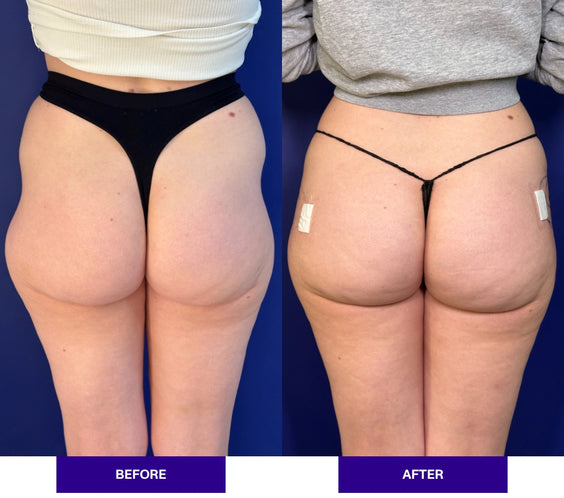 Injectual Hip Dip Filler Treatment