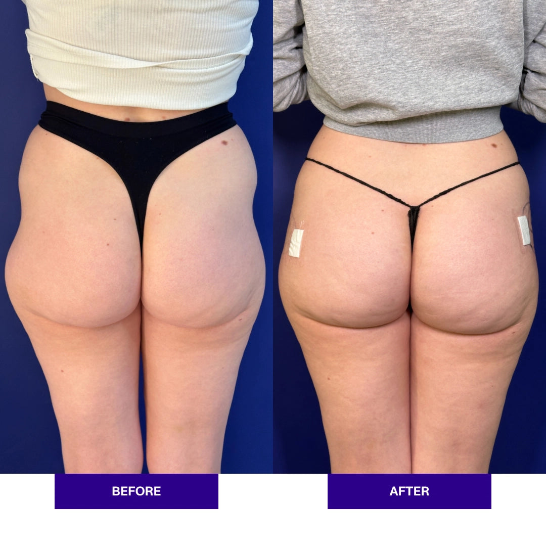 Hip Dip Filler Treatment in London