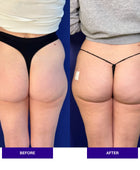 Injectual Buttocks Filler Treatment