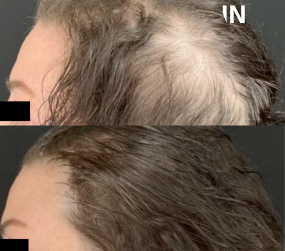 CALECIM® Advanced Hair System