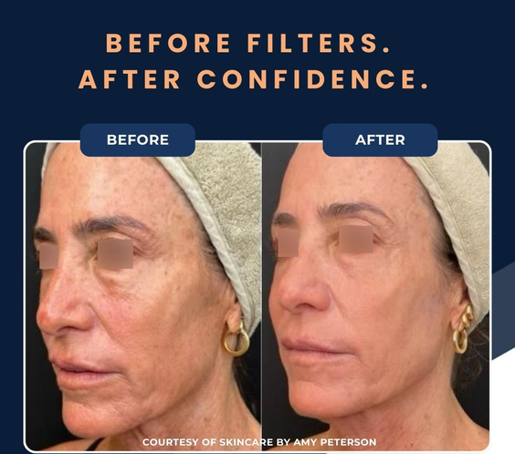 UltraClear Laser Skin Resurfacing