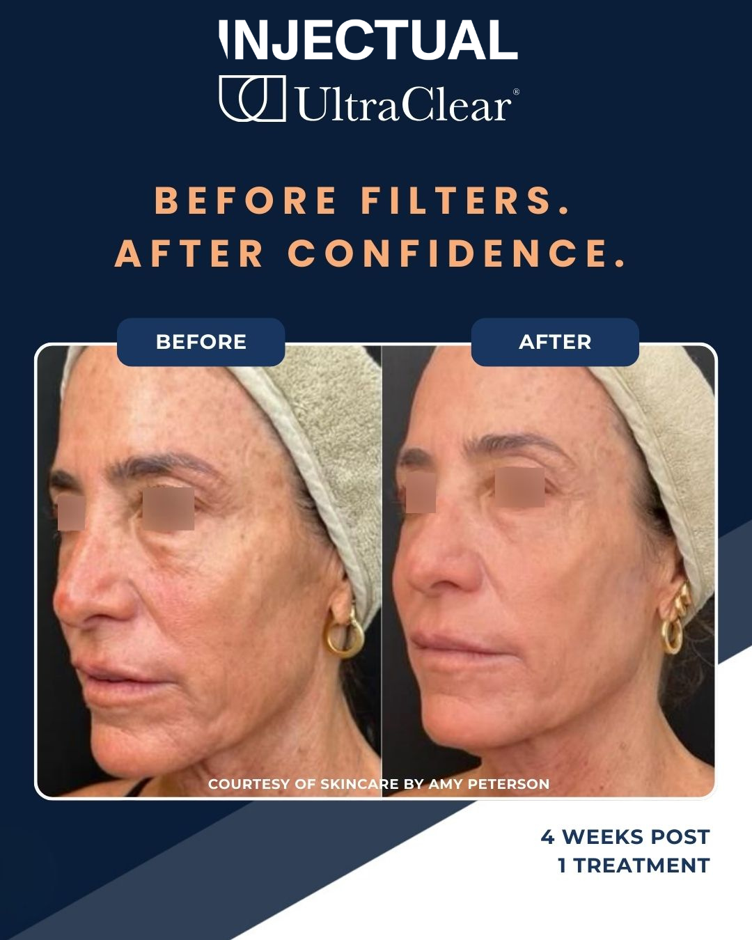 UltraClear Laser Skin Resurfacing