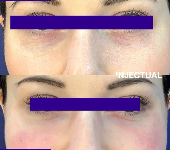 Ameela rejuvenate under eye before and after 