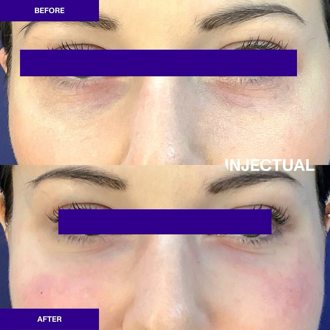 Ameela rejuvenate under eye before and after 