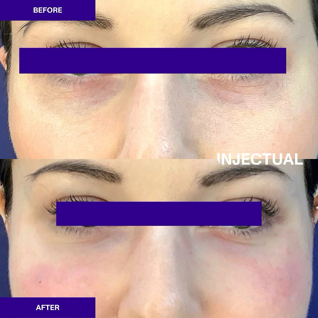 Polynuclear Eye Injection Ameela® (Nucleadyn®) Under Eye Treatment | Injectual