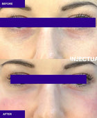 Ameela rejuvenate under eye before and after 