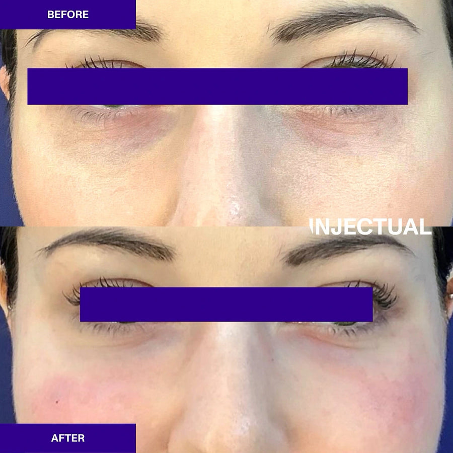 Polynucleotides Ameela® (Nucleadyn®) Under Eye Treatment