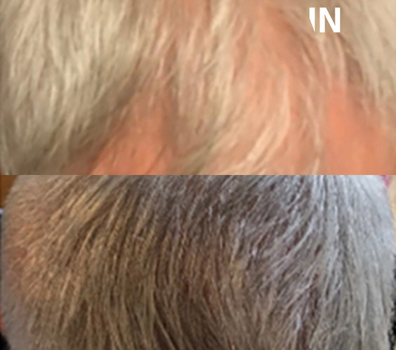 CALECIM® Advanced Hair System