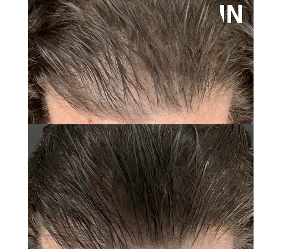CALECIM® Advanced Hair System