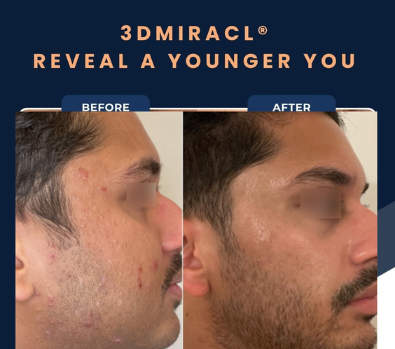 UltraClear Laser Skin Resurfacing