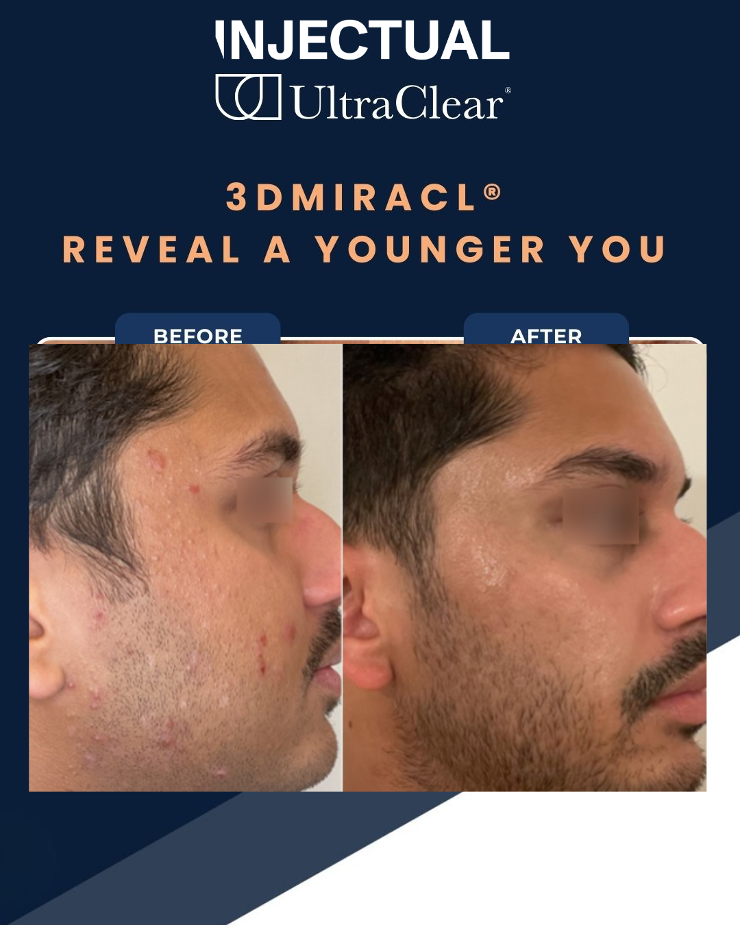 UltraClear Laser Skin Resurfacing