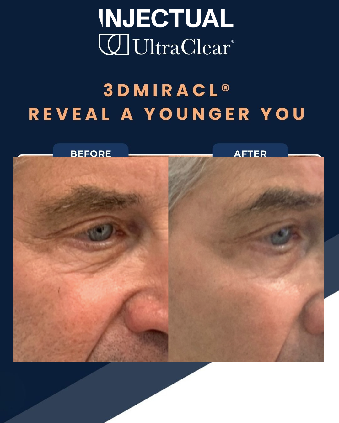 UltraClear Laser Skin Resurfacing