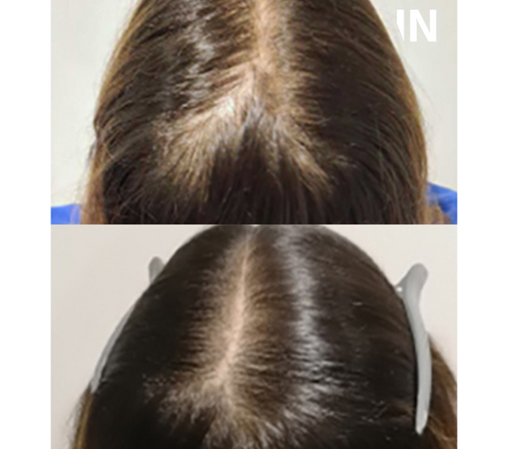 CALECIM® Advanced Hair System