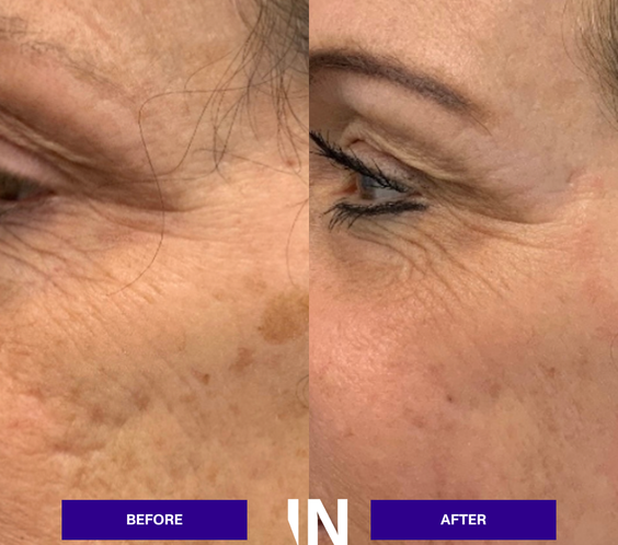 UltraClear Laser Skin Resurfacing