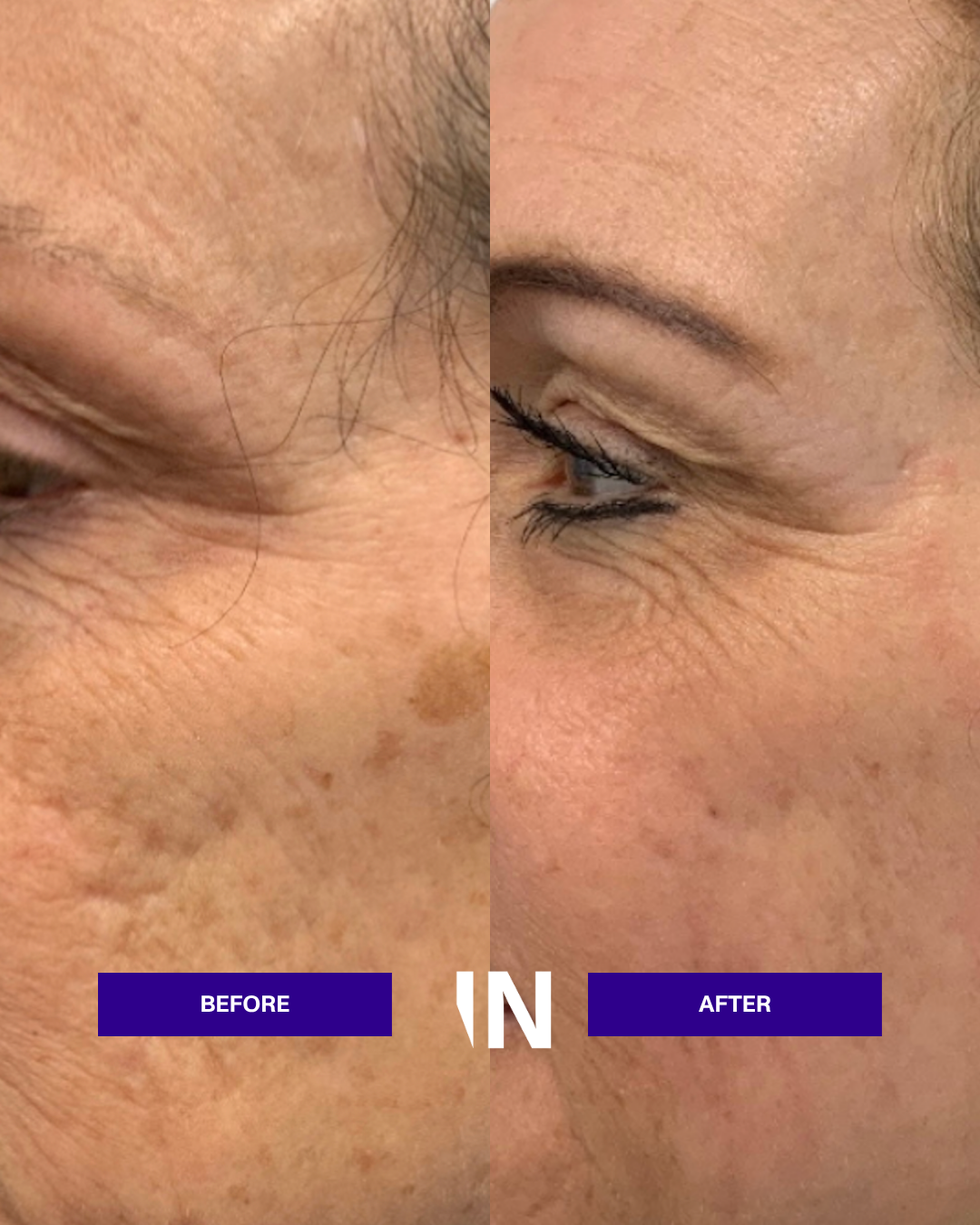 UltraClear Laser Skin Resurfacing