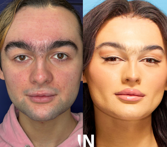 OestroLift™ Injectable Non-surgical Feminisation Protocol