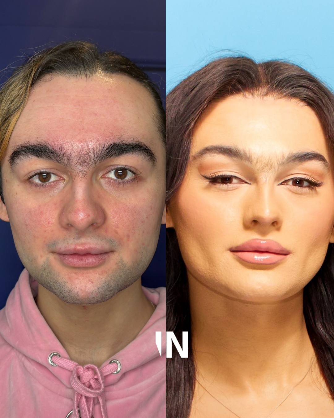 OestroLift™ Injectable Non-surgical Feminisation Protocol