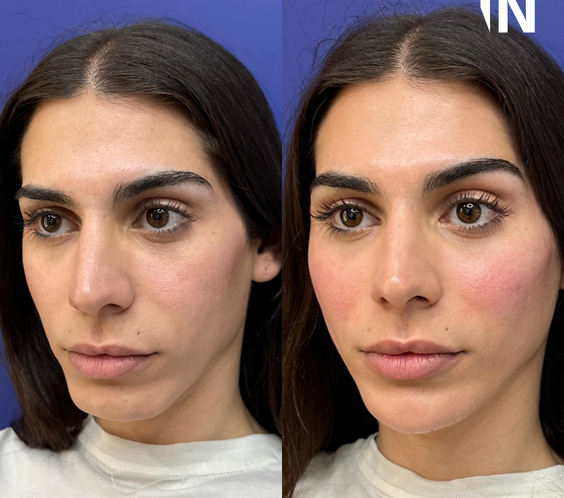 Non-surgical Gender Affirming Treatments