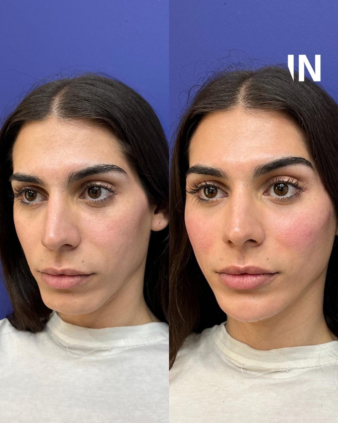 Non-surgical Gender Affirming Treatments