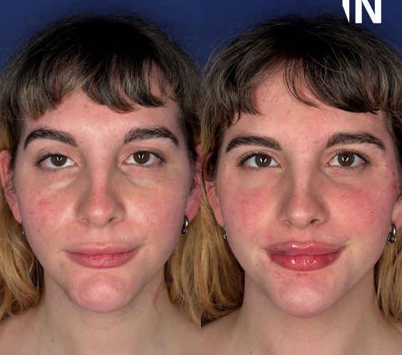 Non-surgical Gender Affirming Treatments