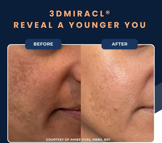 UltraClear Laser Skin Resurfacing