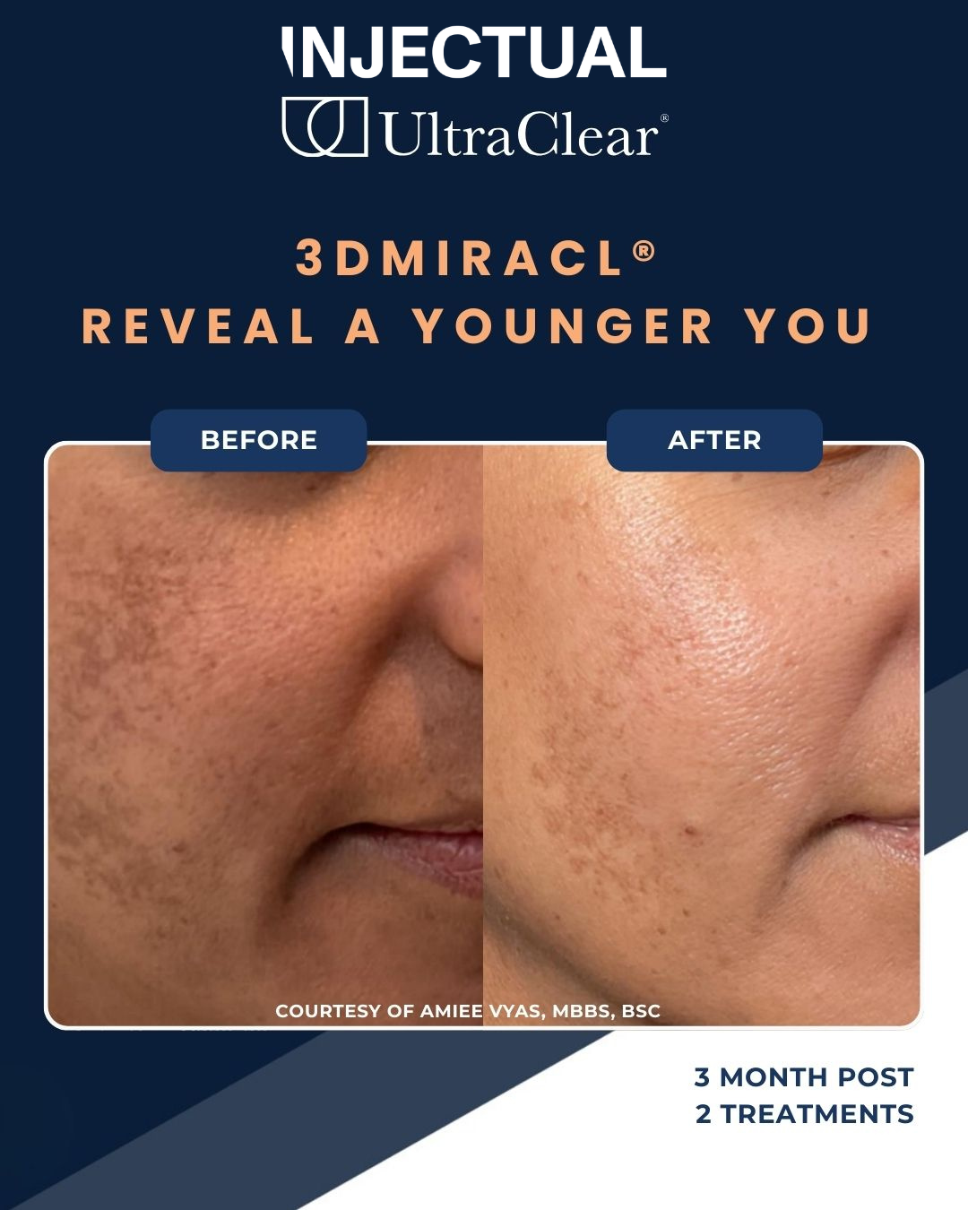 UltraClear Laser Skin Resurfacing