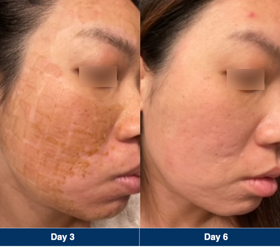 UltraClear Laser Skin Resurfacing
