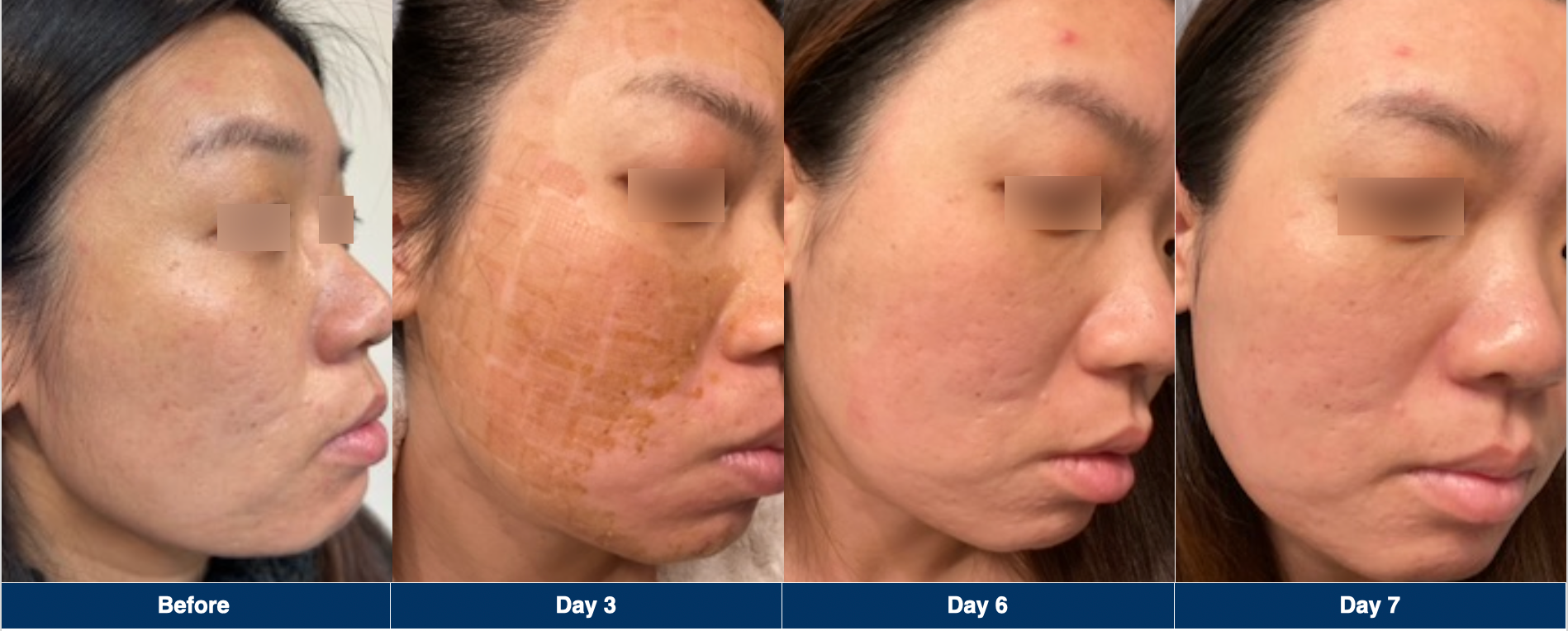 UltraClear Laser Skin Resurfacing