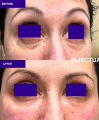 Salmon Sperm Facial Polynucleotides  rejuvenate under eye and face  before and after 