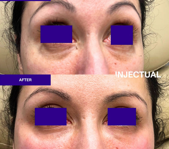 Salmon Sperm Facial Polynucleotides  rejuvenate under eye and face  before and after 