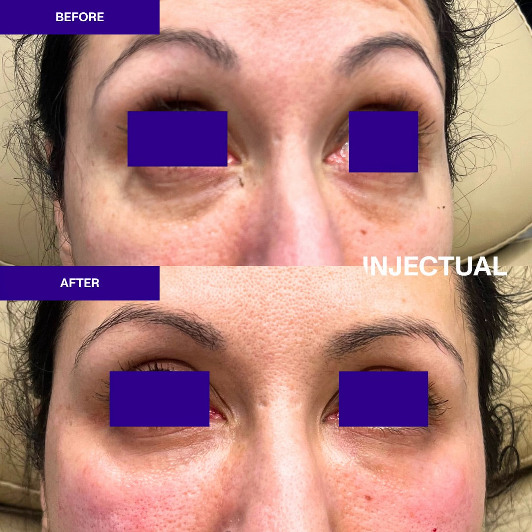 Ameela rejuvenate under eye before and after 