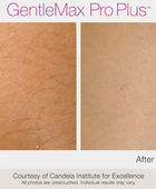 Laser Hair Removal