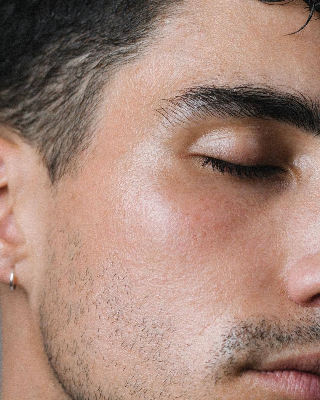 Non-Surgical Blepharoplasty (UltraClear Laser)