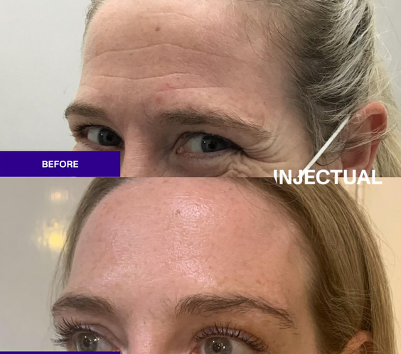 Anti-Wrinkle Treatments