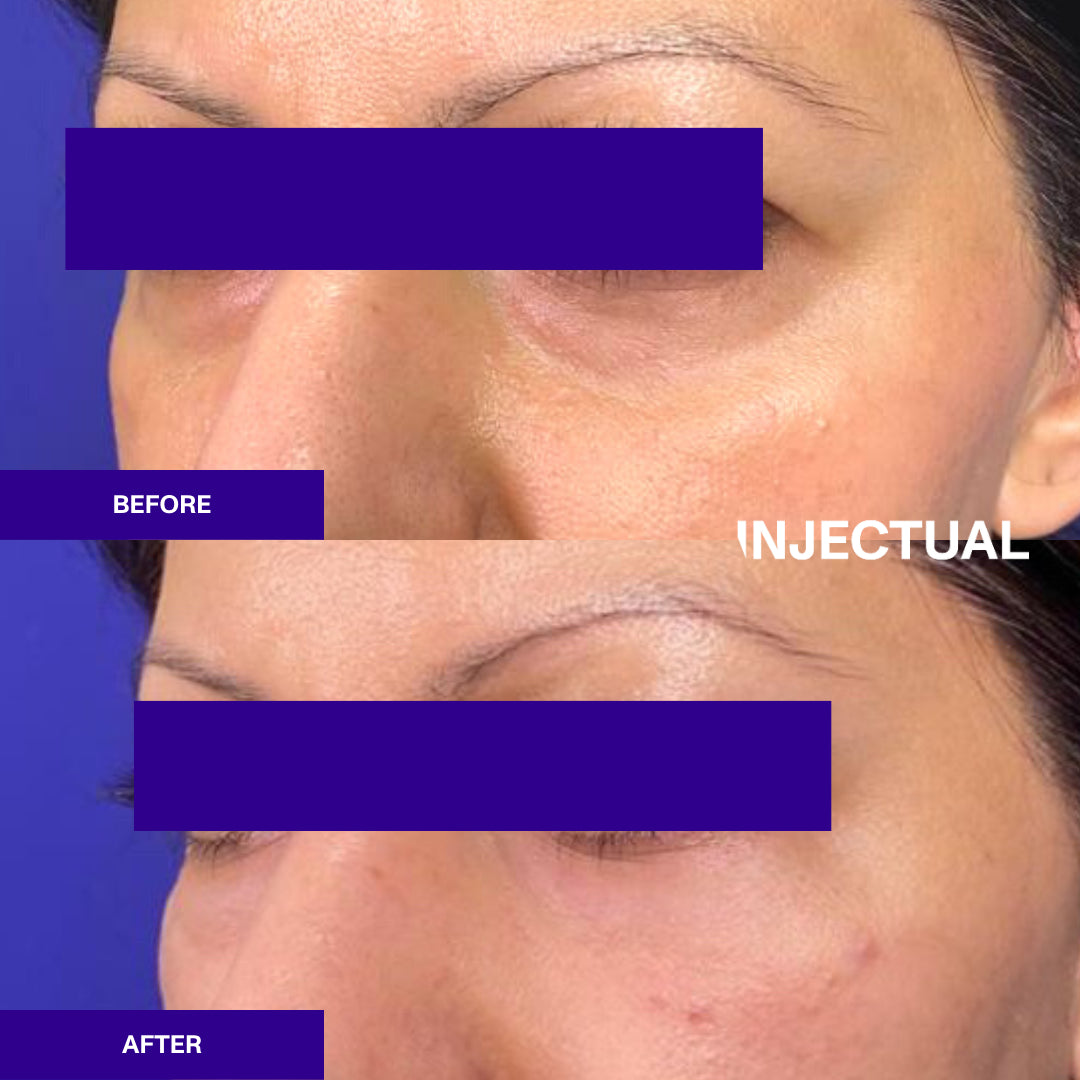 Ameela rejuvenate under eye before and after 