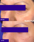 Ameela rejuvenate under eye before and after 