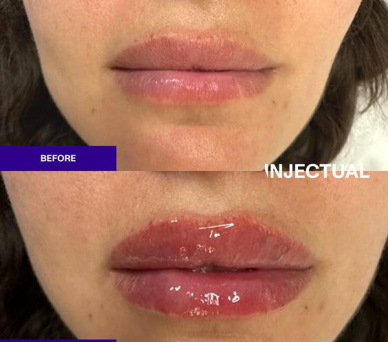 The INJECTUAL Lip